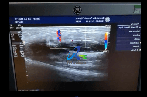GE Logiq S8 Image Interference